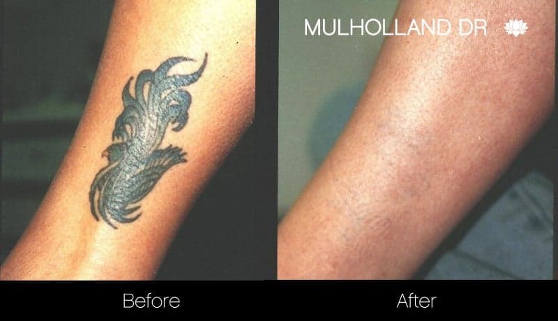 Laser Tattoo Removal - Before and After Gallery – Photo 2