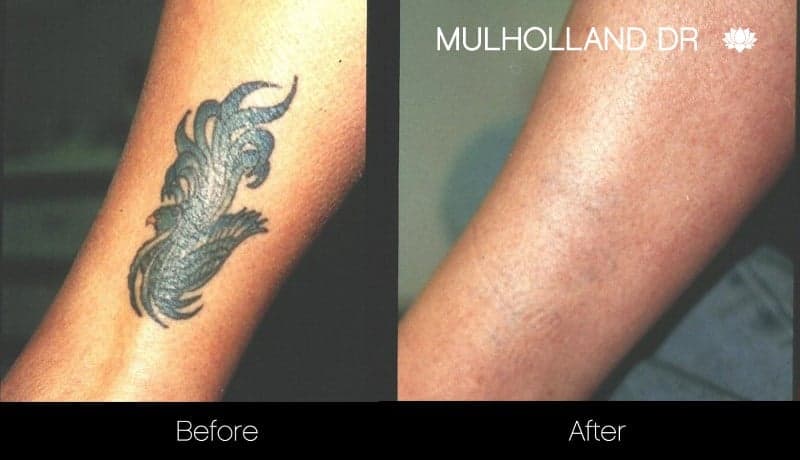 Laser Tattoo Removal Treatment in Beverly Hills CA  Moy Fincher Chipps