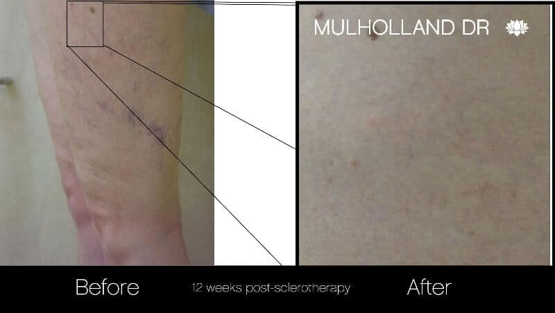 Leg Vein Reduction - Patient Before and After Gallery – Photo 2