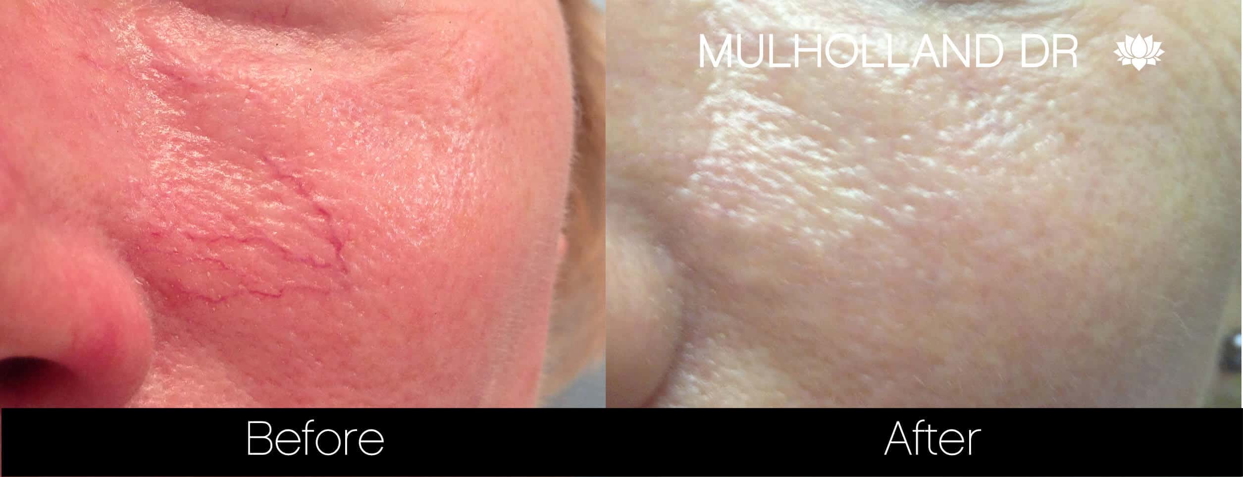 Rosacea Treatment - Patient Before and After Gallery – Photo 3