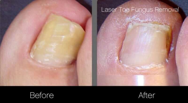Toe Fungus Removal - Patient Before and After Gallery – Photo 2