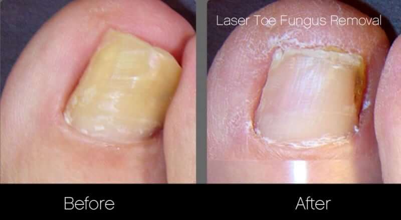 K-Laser Therapy - Using Laser Therapy to Treat Fungal Nails | Hurst Podiatry