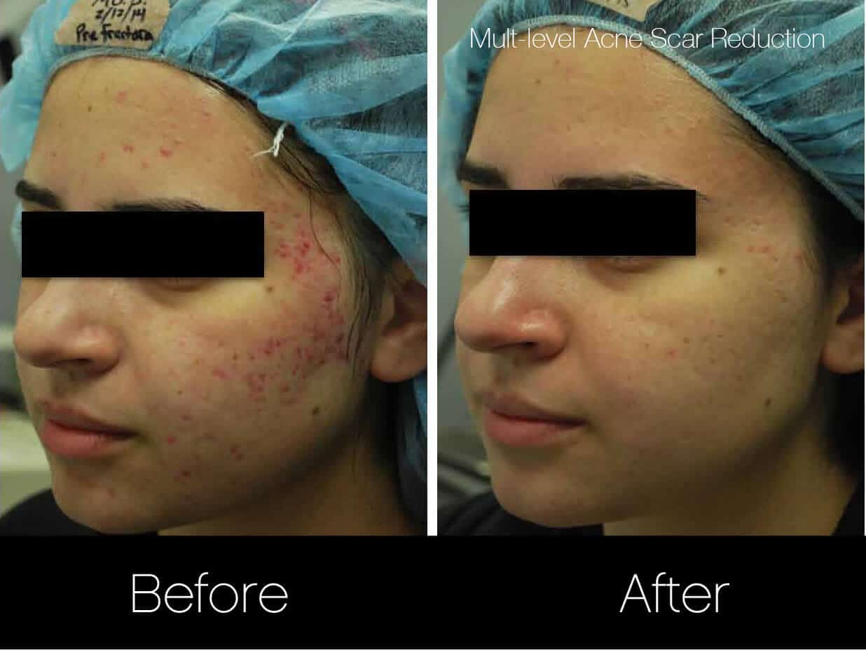 Acne Scar Treatments - Before and After Gallery – Photo 2