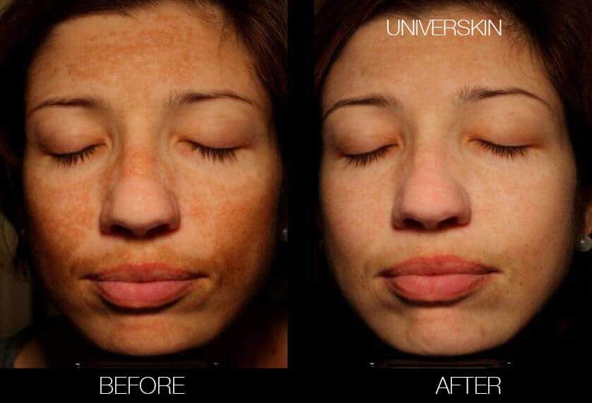 The image is a before-and-after representation of a face that has undergone a Universkin skincare treatment, showing notable improvement in skin tone and texture, with a reduction in hyperpigmentation and a more even complexion in the "after" image.