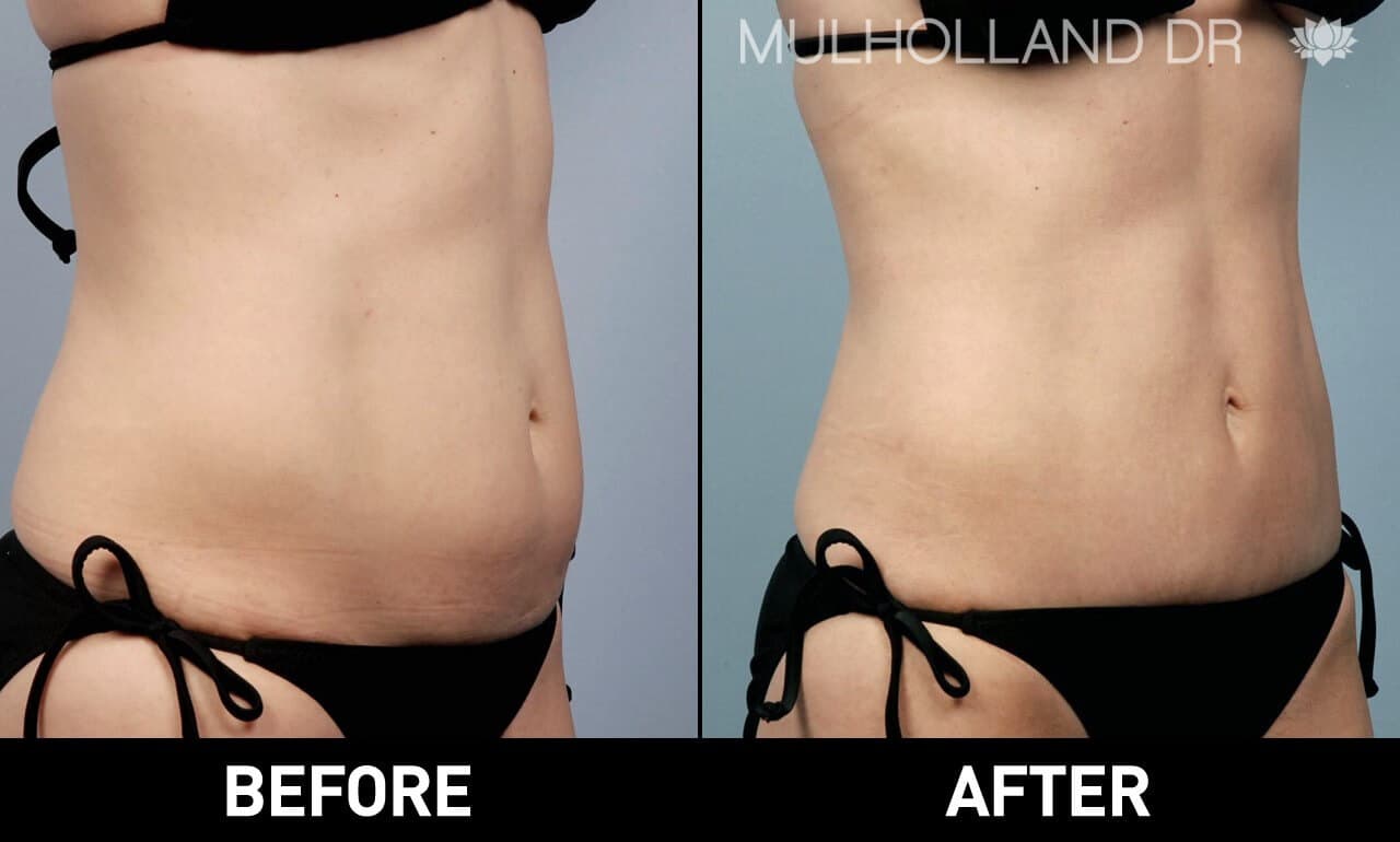 Smart Lipo - Before and After Gallery – Photo 2