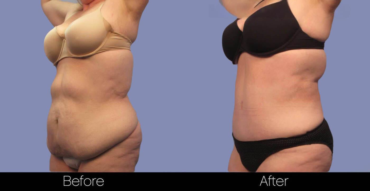 Tummy Tuck - Before and After Gallery – Photo 2