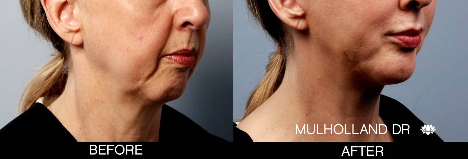 Chin Implant - Before and After Gallery – Photo 2