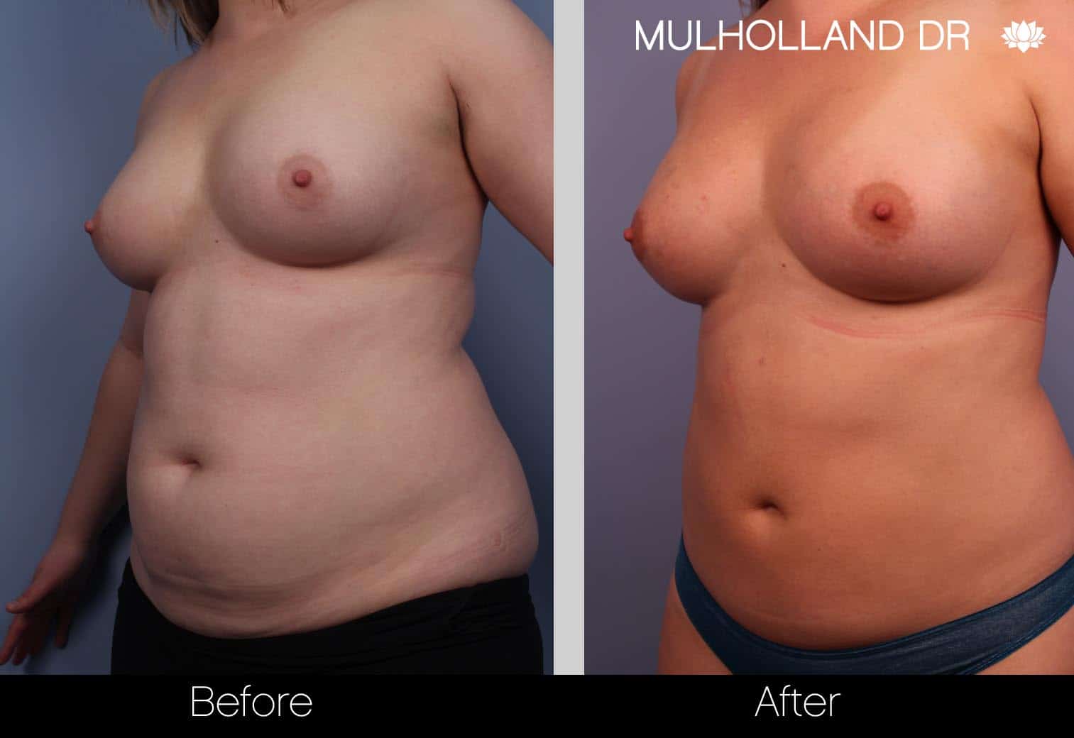 Fat Grafting Breast Augmentation - Before and After Gallery – Photo 2