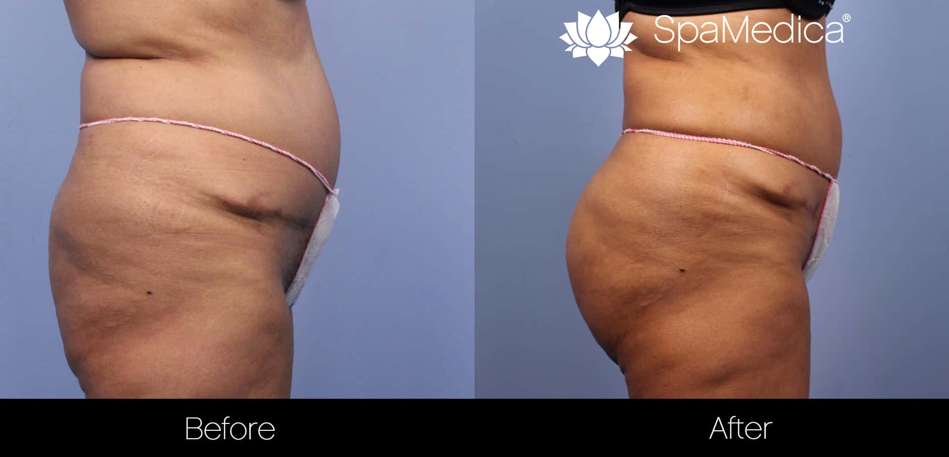 Brazilian Butt Lift - Before and After Gallery – Photo 2