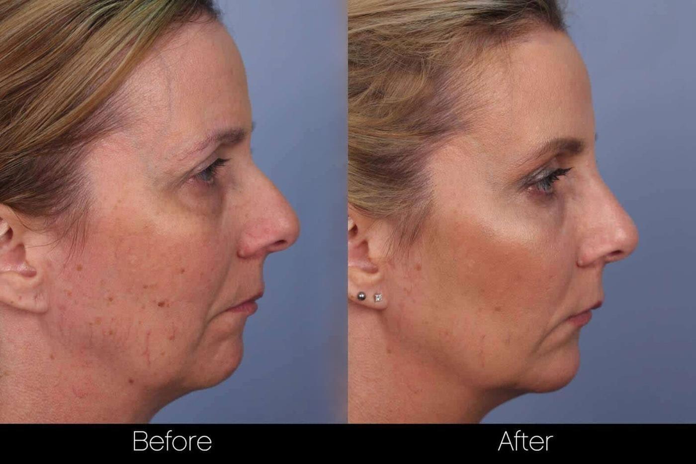 FotoFacial - Before and After Gallery – Photo 9