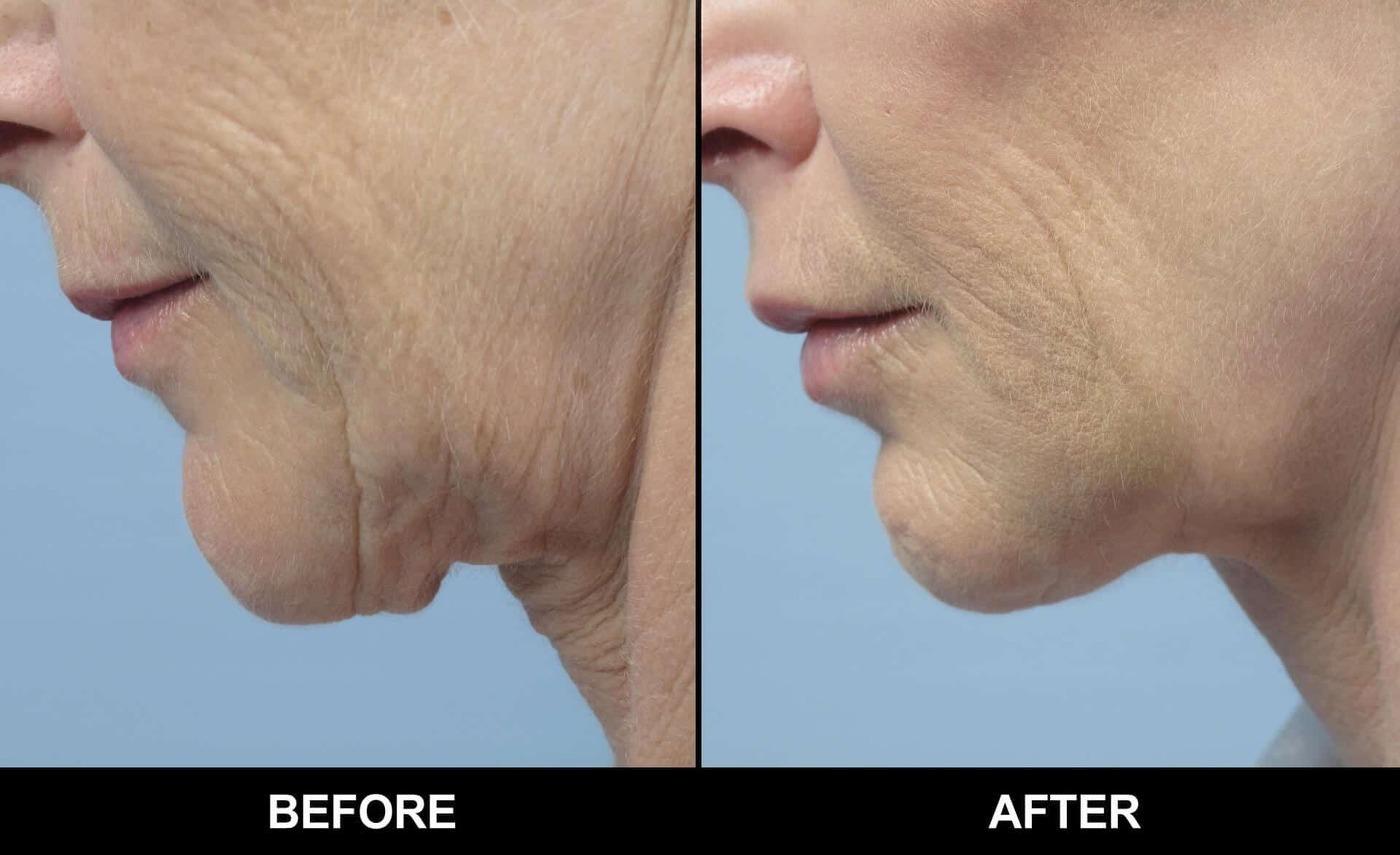 Microdermabrasion - Before and After Gallery – Photo 18