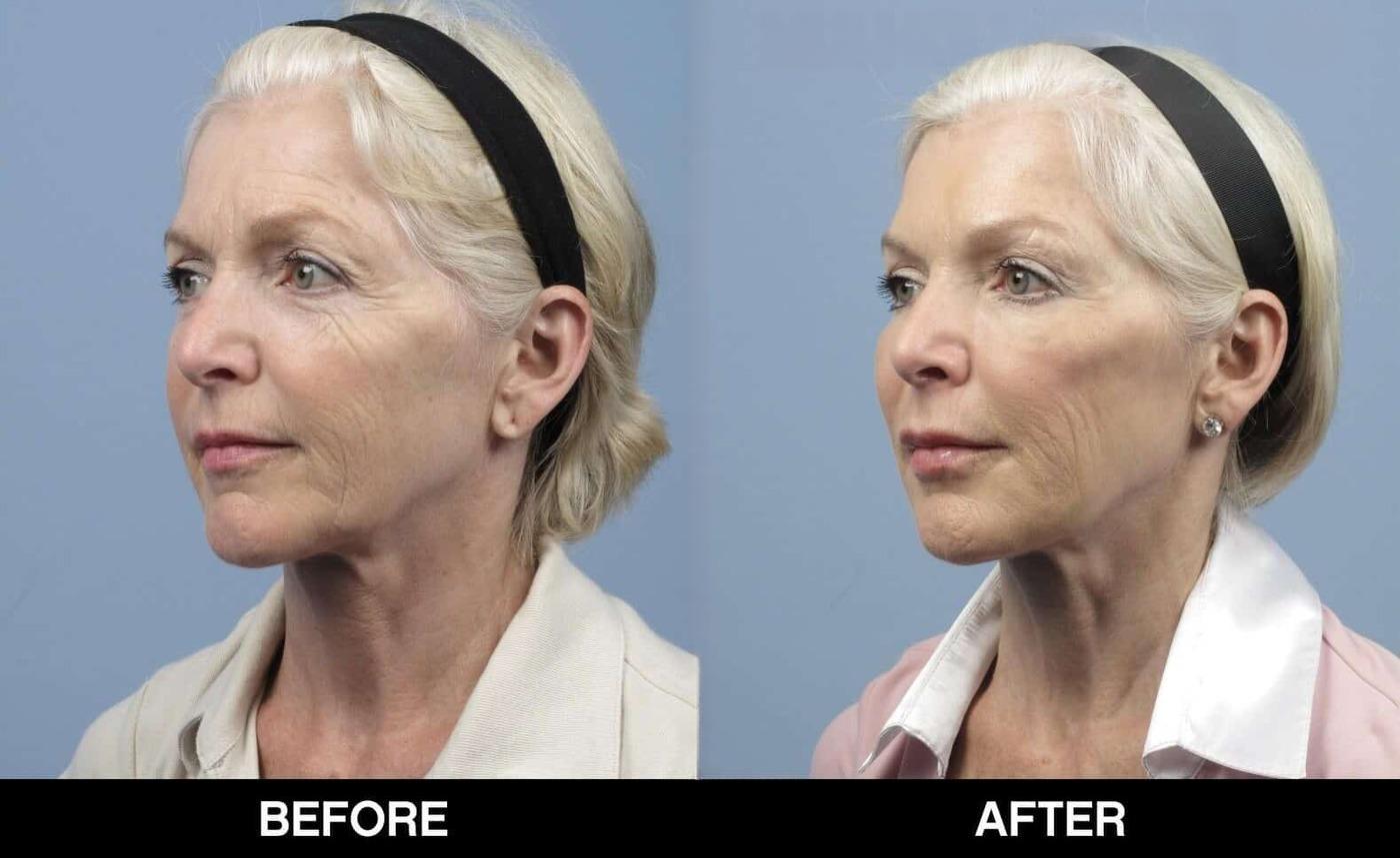 Microdermabrasion - Before and After Gallery – Photo 20