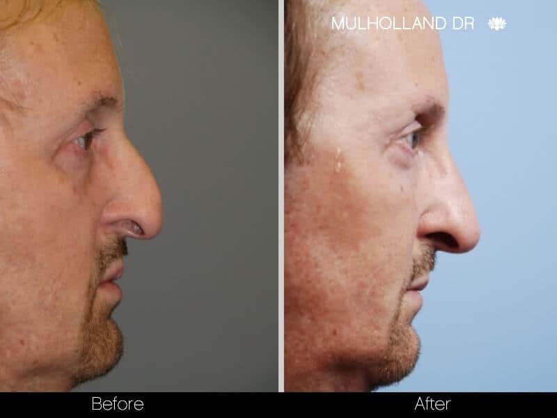 A side-by-side comparison of a man's profile showing his nose before and after a non-surgical nose job procedure.