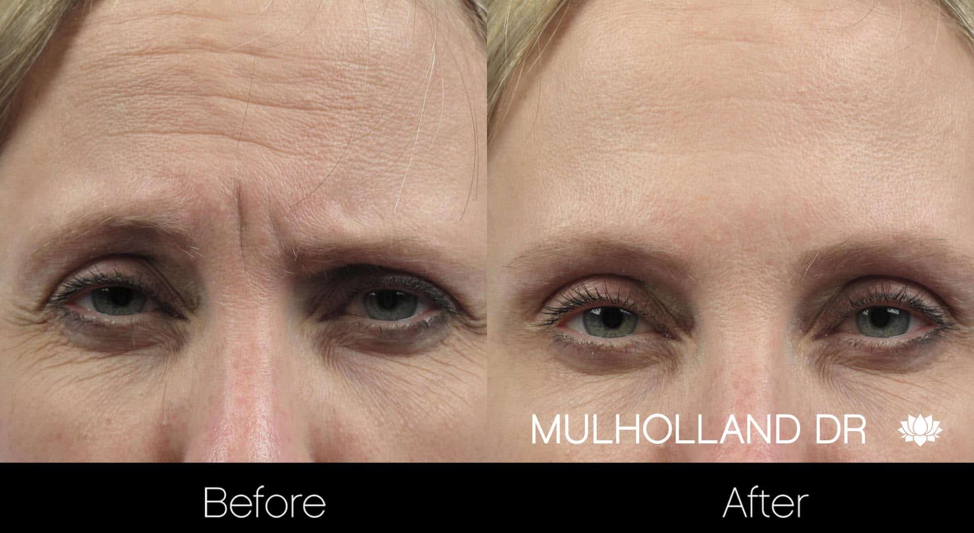 Botox Injectable - Before and After Gallery – Photo 3