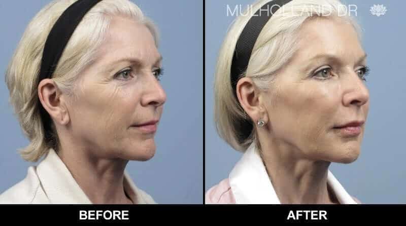 Non-Surgical Facelift - Before and After Gallery – Photo 3