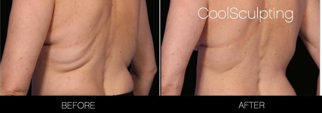 CoolSculpting - Before and After Gallery – Photo 3