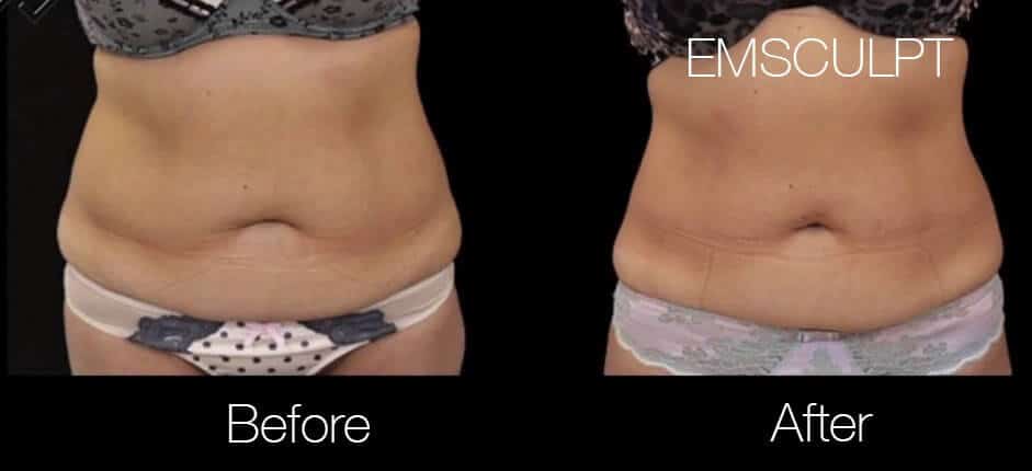 Emsculpt - Before and After Gallery – Photo 3