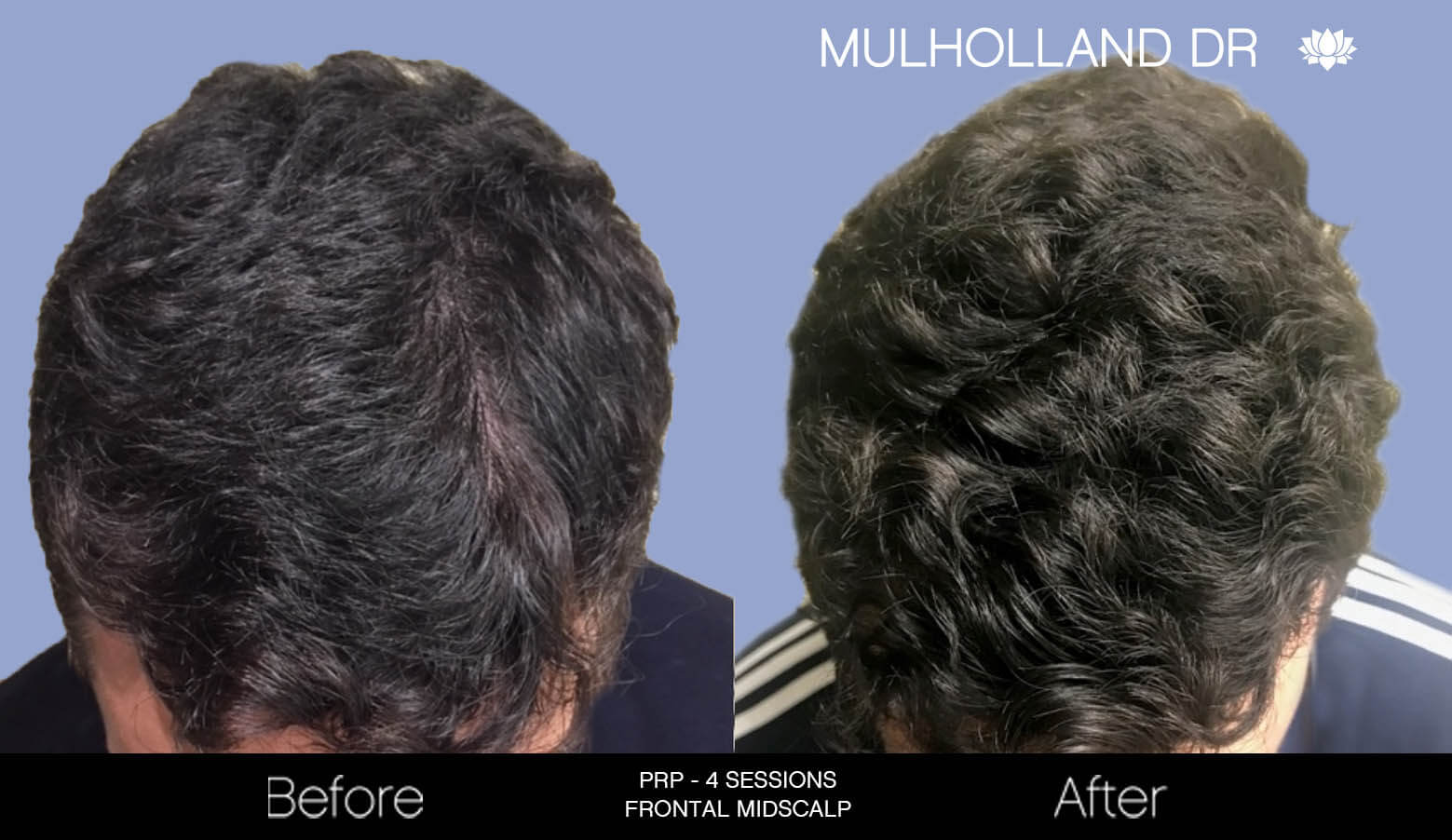 Non Surgical Hair Restoration Patient 1 Spamedica