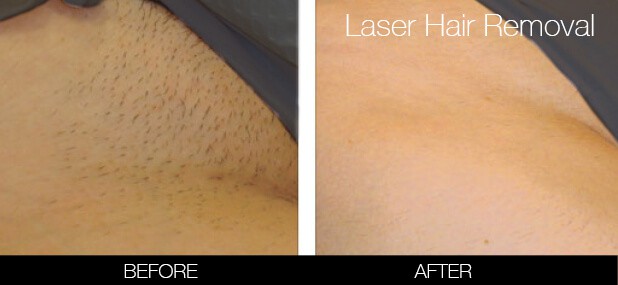 Bikini Laser Hair Removal Pain Ingrown hairs  Styles  YouTube