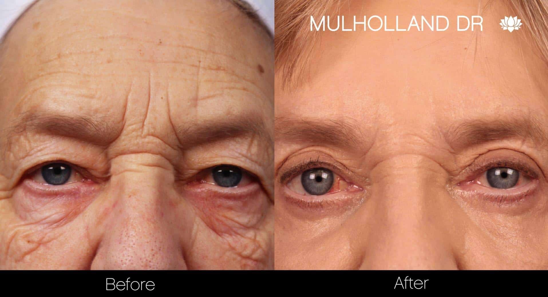 Facial Resurfacing and Rejuvenation - Before and After Gallery – Photo 3