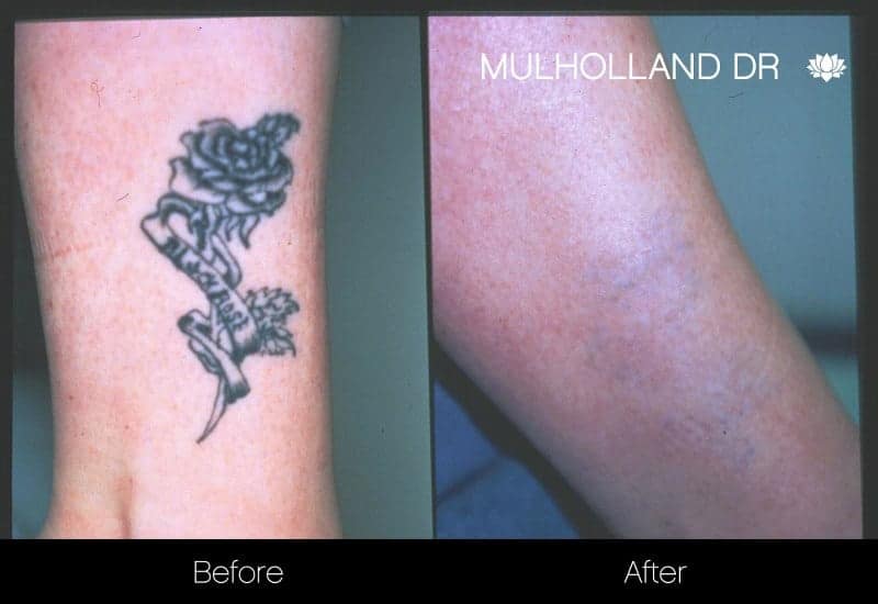 Laser Tattoo Removal - Before and After Gallery – Photo 3