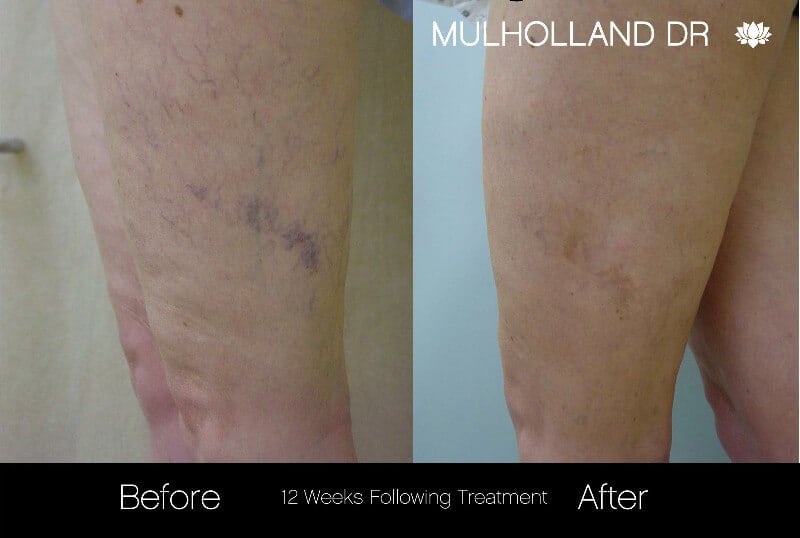 Leg Vein Reduction - Patient Before and After Gallery – Photo 3