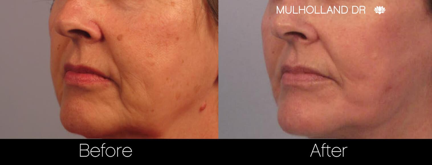 image3 non surgical laser skin treatmens mole removal
