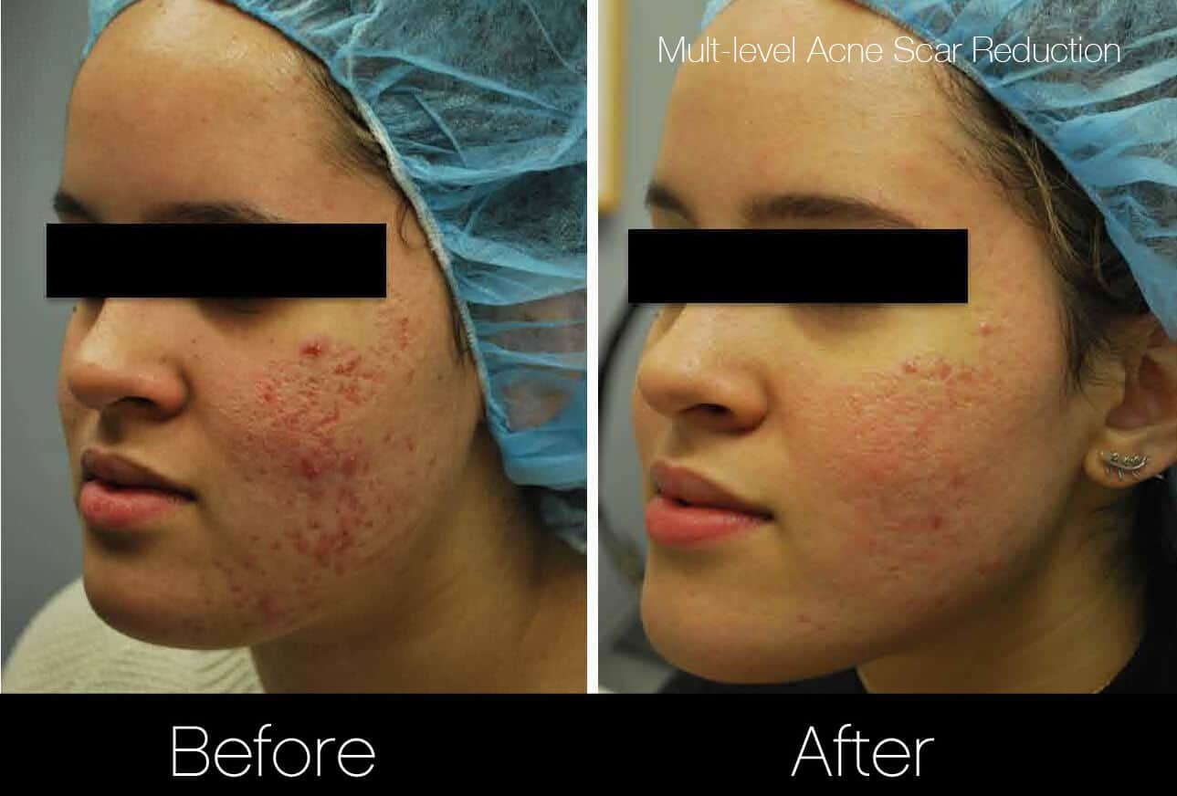 Acne Scar Treatments - Before and After Gallery – Photo 3