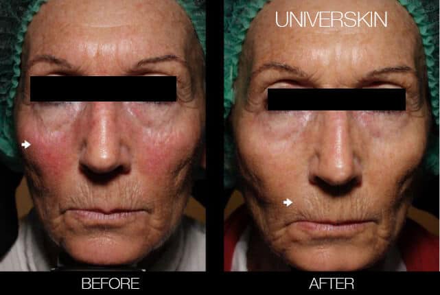 Universkin - Before and After Gallery – Photo 4