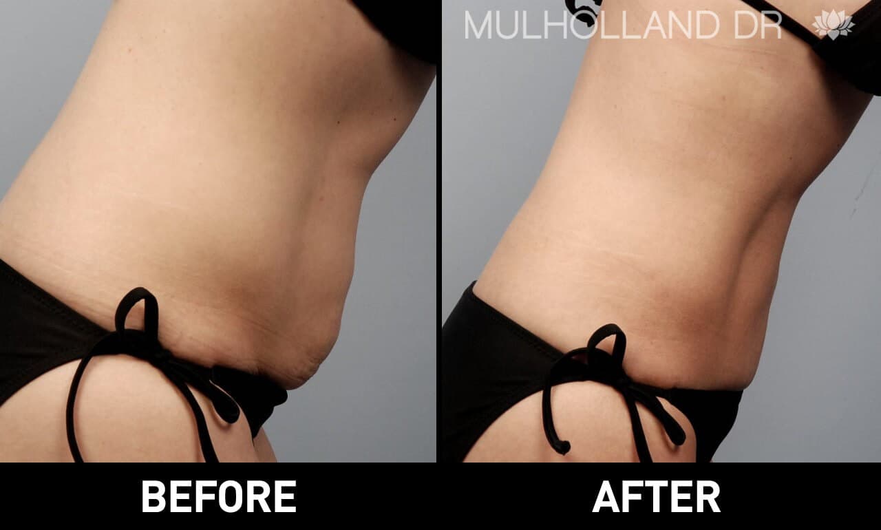 Smart Lipo - Before and After Gallery – Photo 3