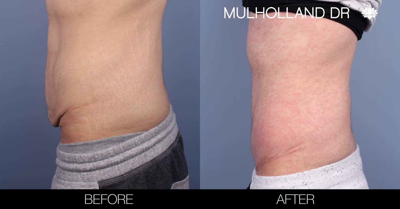Male Tummy Tuck (Belt Lipectomy) - Before and After Gallery – Photo 3