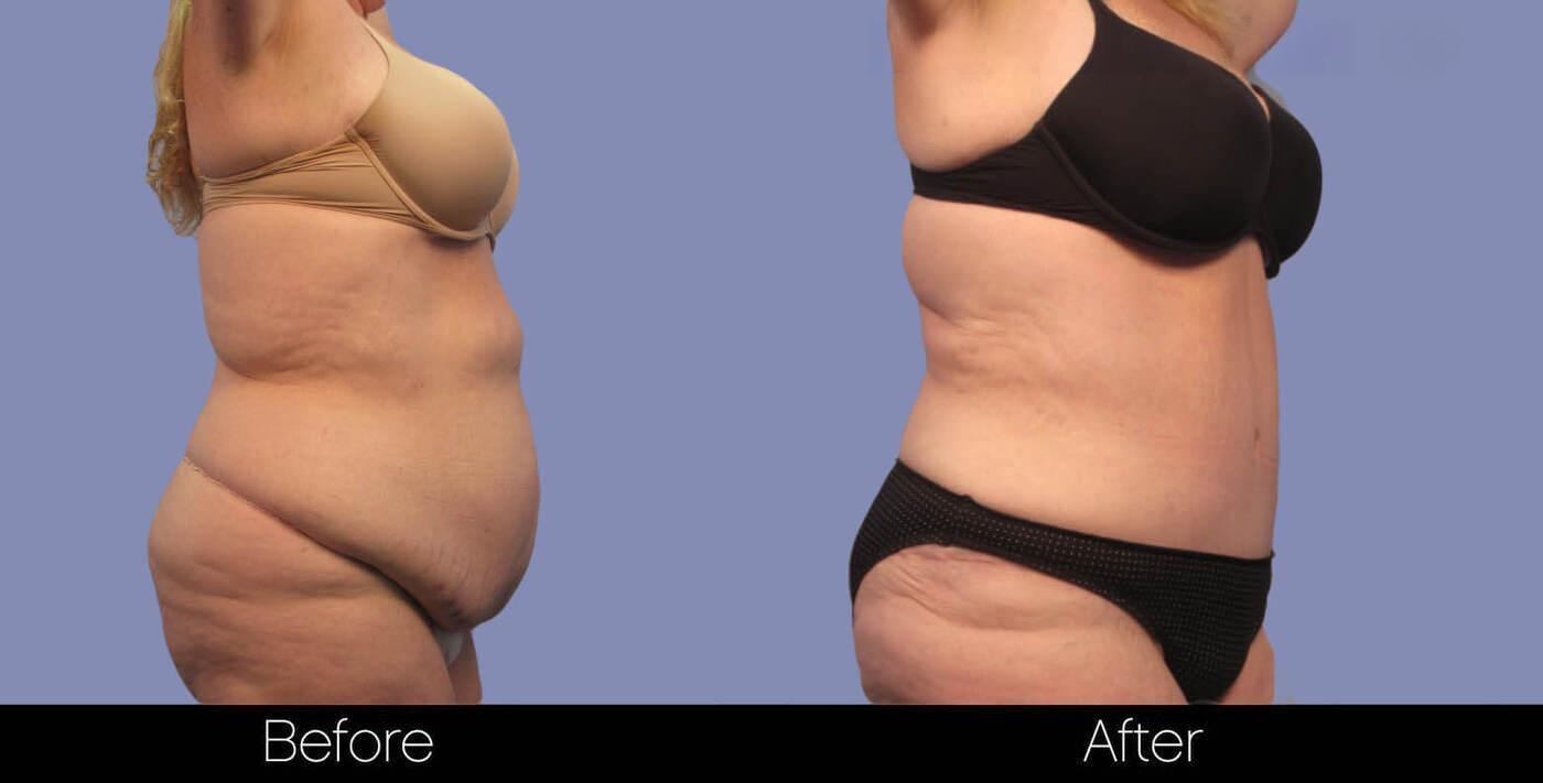 Tummy Tuck - Before and After Gallery – Photo 3