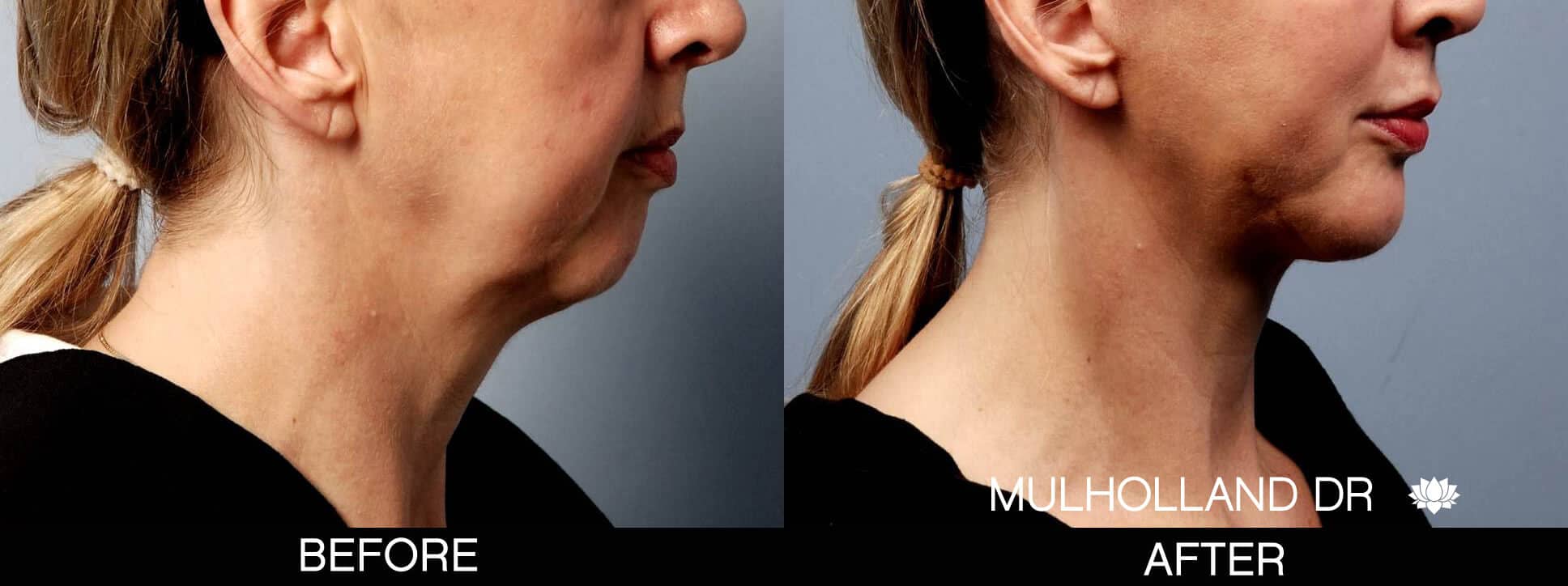 Chin Implant - Before and After Gallery – Photo 3