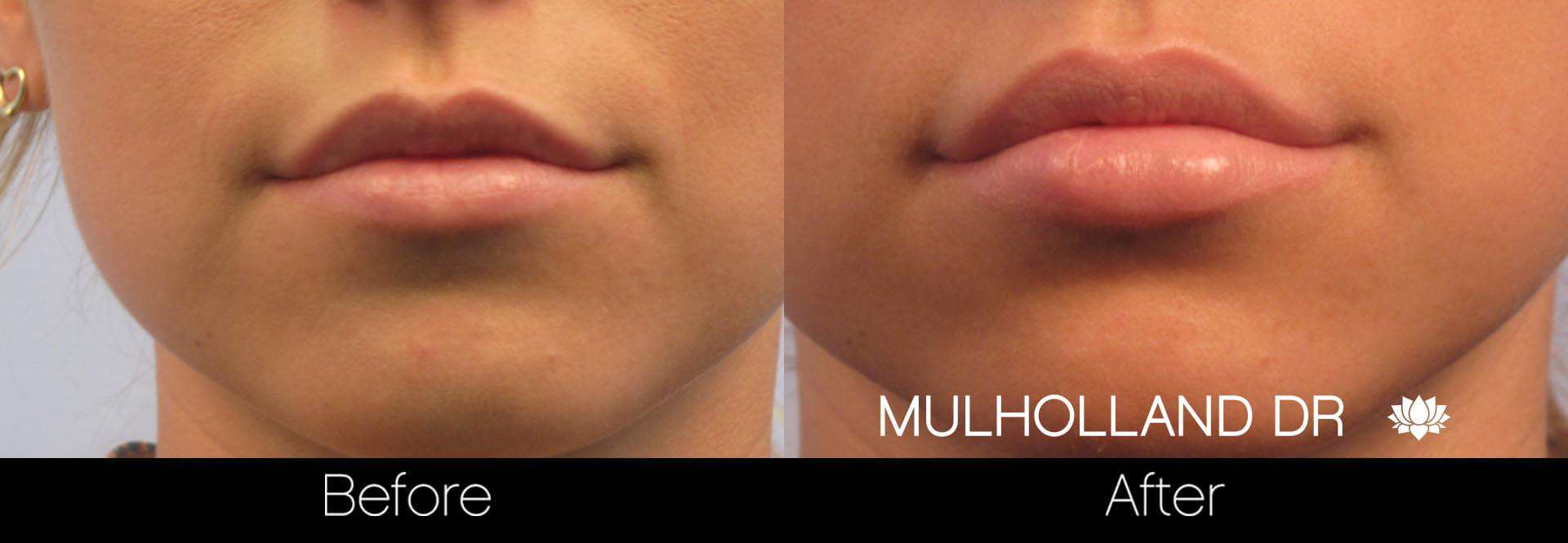 Lip Augmentation- Before and After Gallery – Photo 4