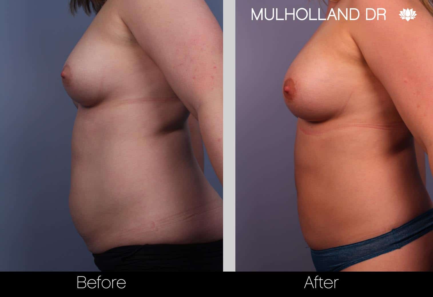 Fat Grafting Breast Augmentation - Before and After Gallery – Photo 3