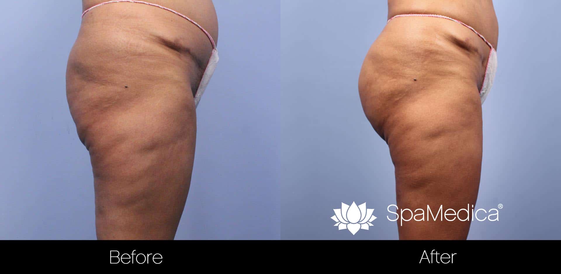 Brazilian Butt Lift - Before and After Gallery – Photo 3