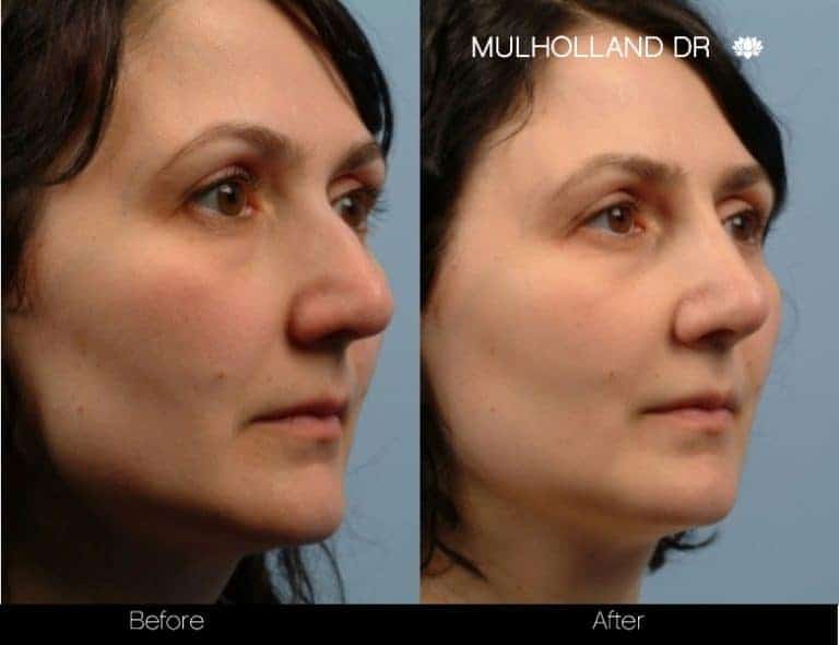 5 Minute Nose Job - Patient 4