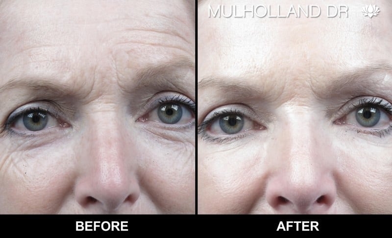 Botox Injectable - Before and After Gallery – Photo 4