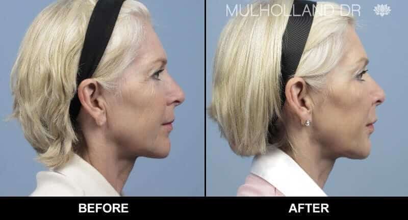 Non-Surgical Facelift - Before and After Gallery – Photo 4