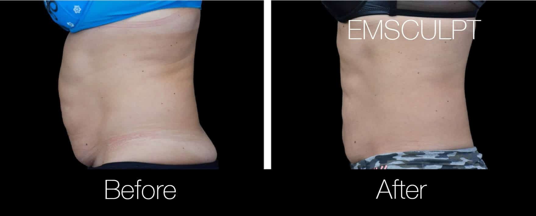 Emsculpt - Before and After Gallery – Photo 1