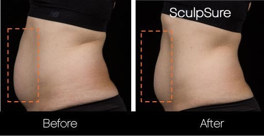 SculpSure - Before and After Gallery – Photo 5