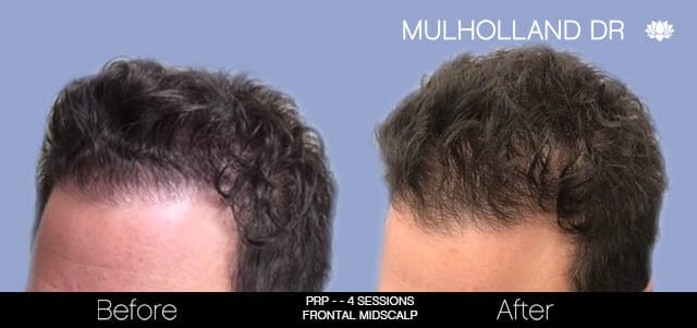 Non-Surgical Hair Restoration - Patient Before and After Gallery – Photo 4