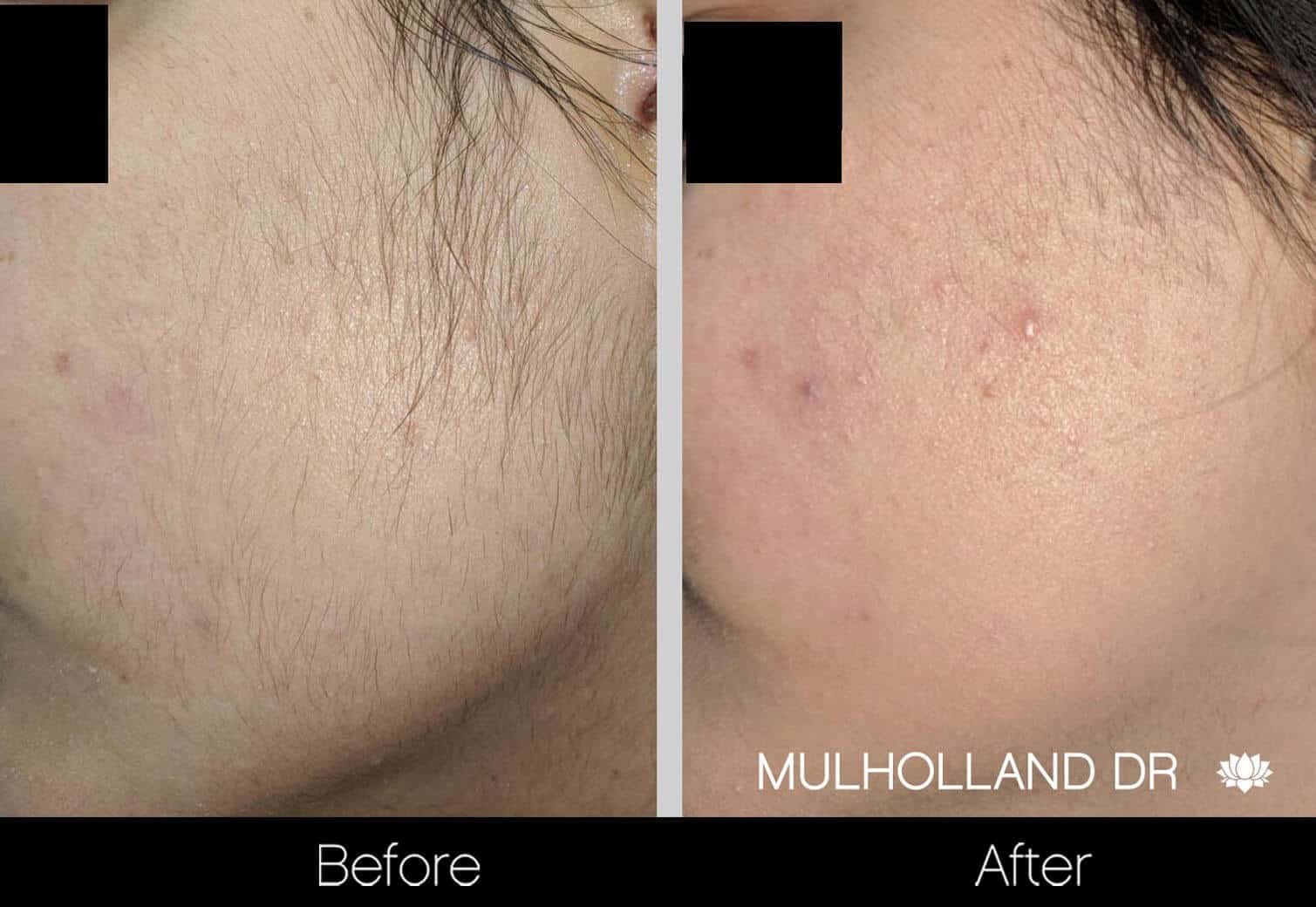 Laser Hair Removal - Patient Before and After Gallery – Photo 4