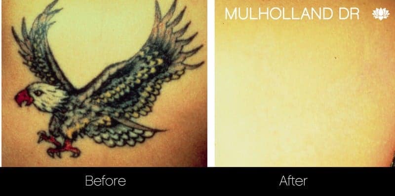 Laser Tattoo Removal - Before and After Gallery – Photo 4
