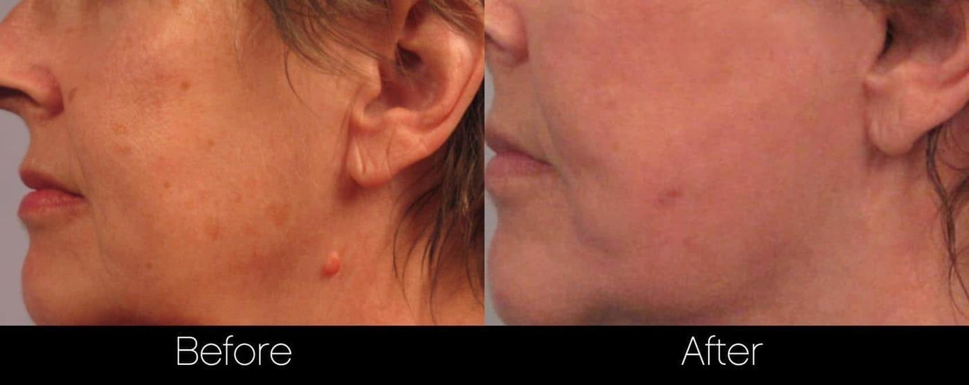 Mole Removal - Patient Before and After Gallery – Photo 4
