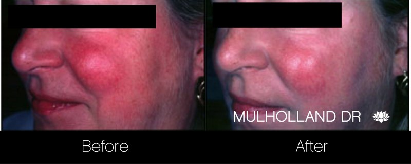 Rosacea Treatment - Patient Before and After Gallery – Photo 6