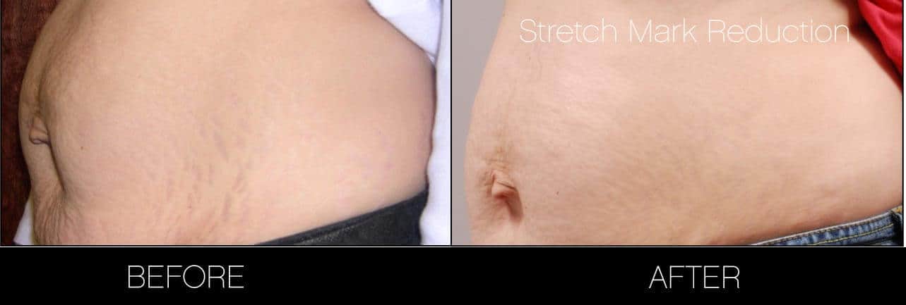 Laser Stretch Mark Removal - Patient Before and After Gallery – Photo 5
