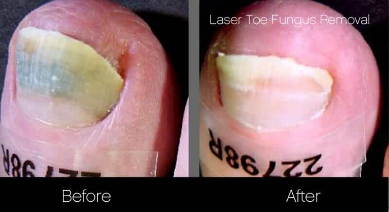 Toe Fungus Removal - Patient Before and After Gallery – Photo 4