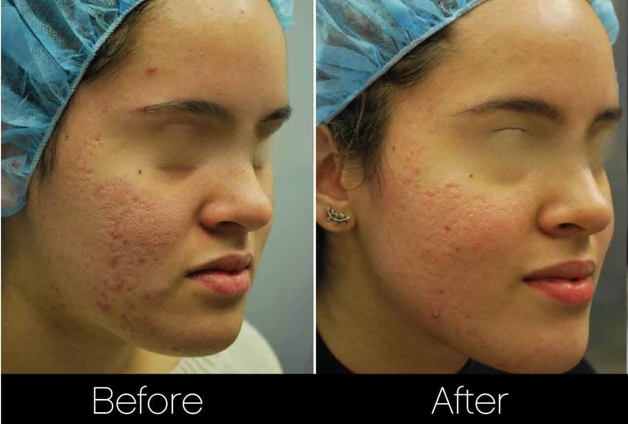 Acne Scar Treatments - Before and After Gallery – Photo 4