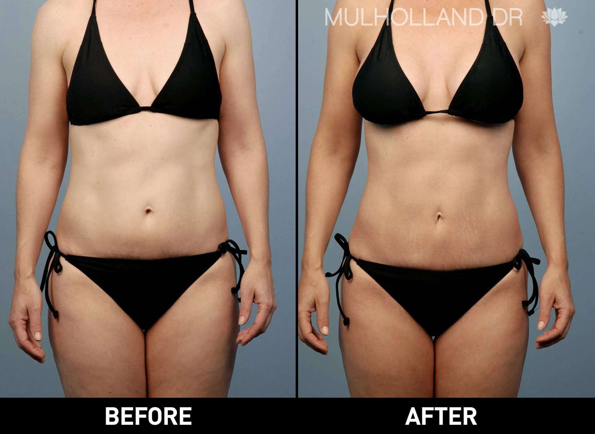 Smart Lipo - Before and After Gallery – Photo 4